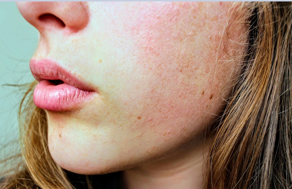 Les pores bouchés, quelles conséquences sur la peau ?