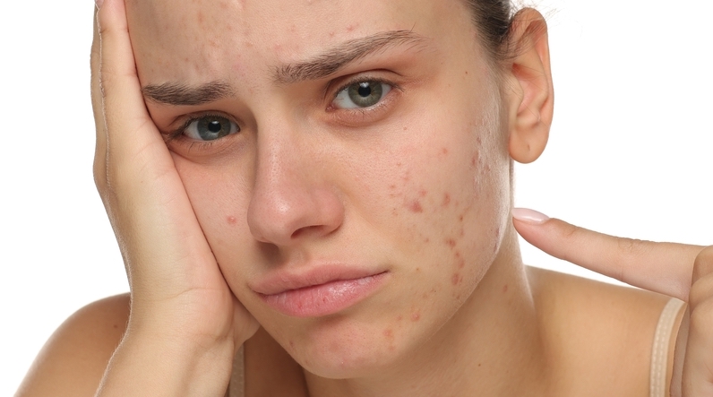 Crème pour peau acnéique : guide complet anti-imperfections 2025