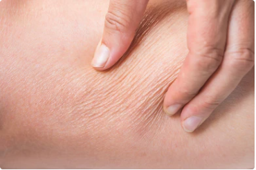 Peau qui tiraille : signe d'une déshydratation intense